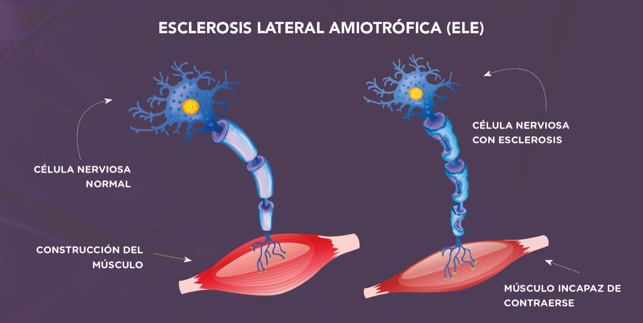 ELA, enfermedad progresiva del sistema nervioso