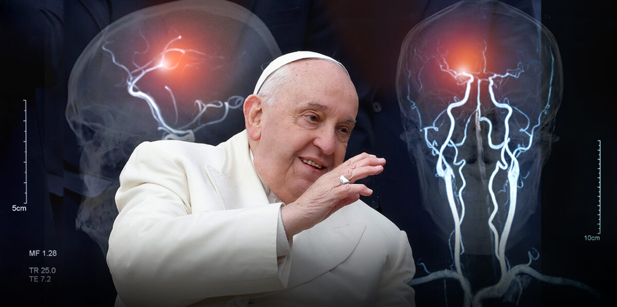 Ictus cerebral: la causa detrás de la muerte del papa Francisco que debes conocer