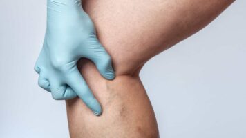 ¿Qué es la insuficiencia venosa? La enfermedad que le diagnosticaron a Trump