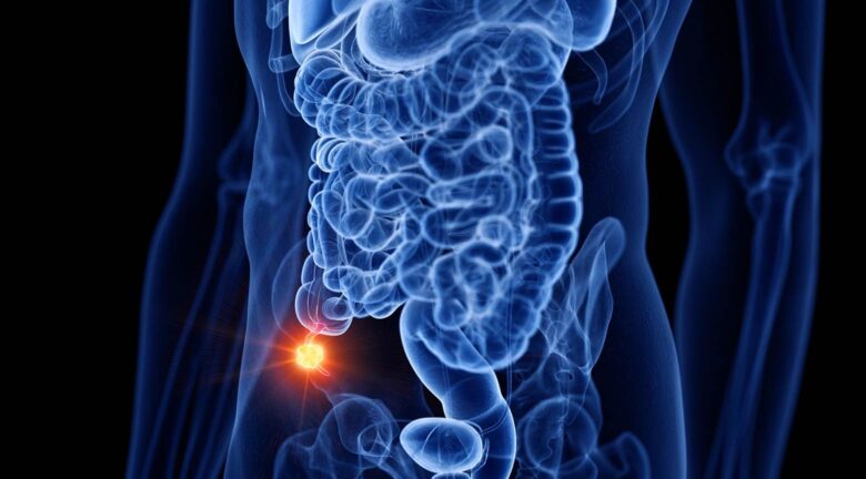 Cáncer de apéndice aumenta en jóvenes y alarma a expertos