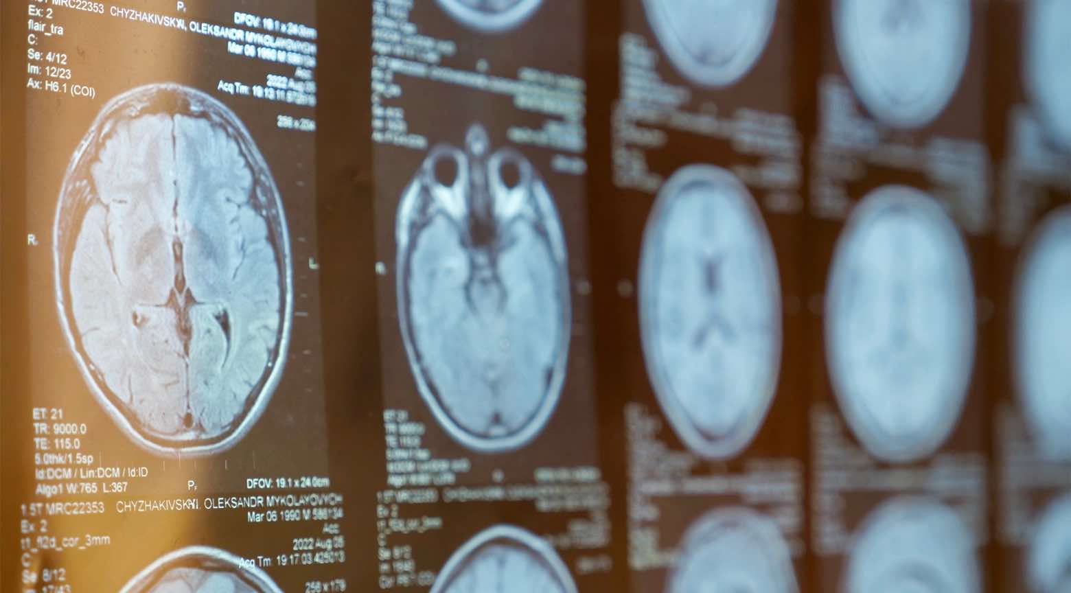 Esclerosis múltiple y productividad en riesgo en Latinoamérica