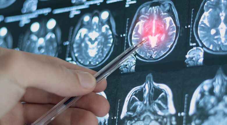 Especialista señala una resonancia magnética del cerebro con una zona resaltada.