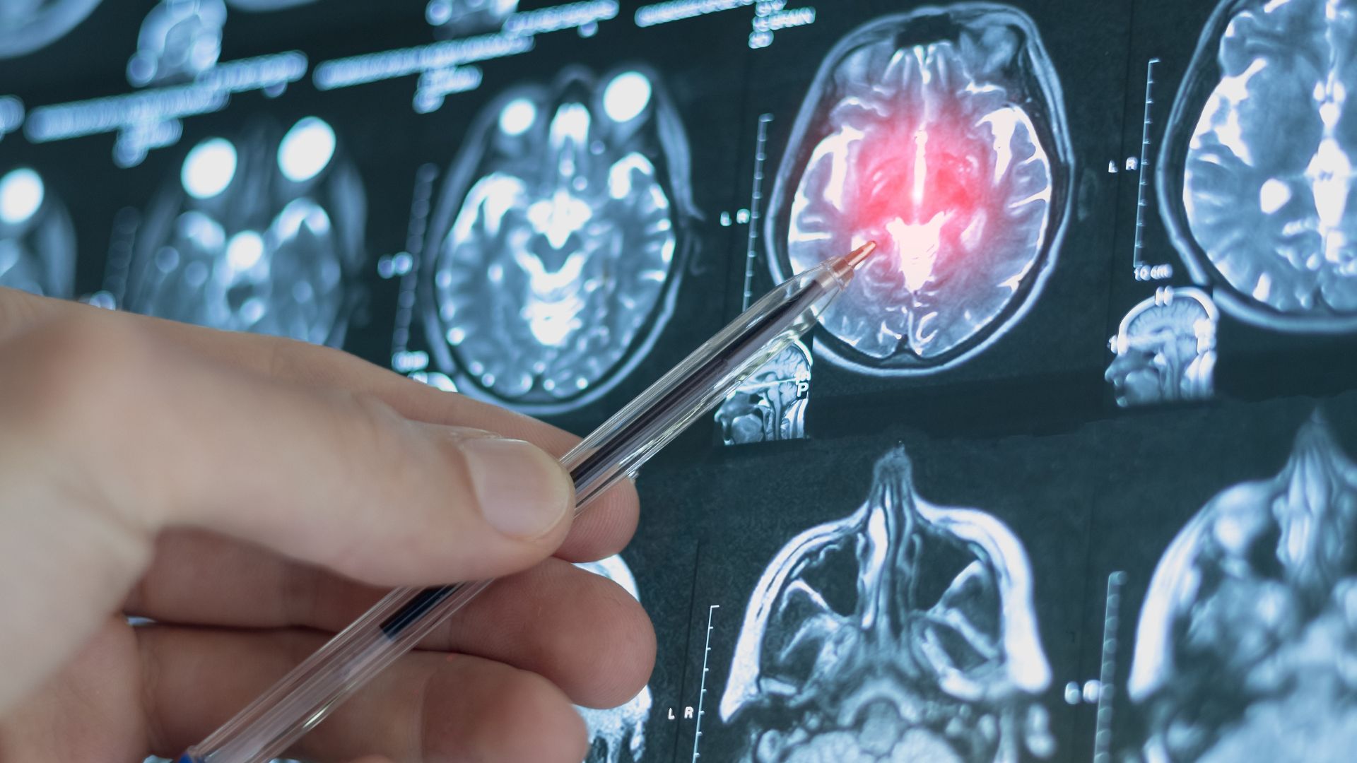 Especialista señala una resonancia magnética del cerebro con una zona resaltada.