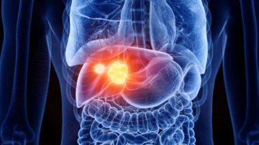 Hígado graso: Las señales de alerta que tu cuerpo envía y podrías estar ignorando
