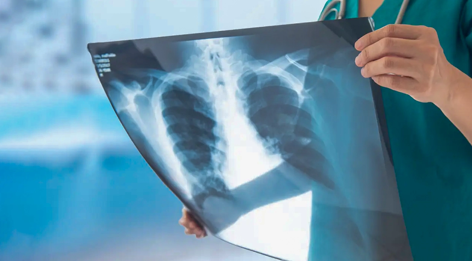 Mano de un médico sosteniendo una radiografía de tórax mostrando los pulmones.