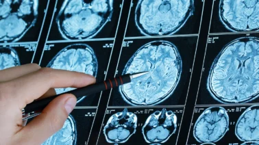 ¿Cómo empieza la demencia? 10 señales tempranas para detectar el Alzheimer a tiempo