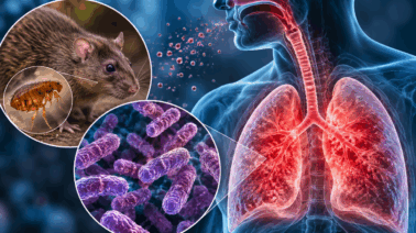 Qué es la peste pulmonar y cómo se contagia? Síntomas y riesgos de la enfermedad